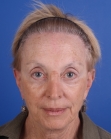 After Hair Transplant &nbsp;Hair Thinning